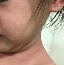 allergic reaction hives on face